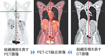 PET-CT融合画像
