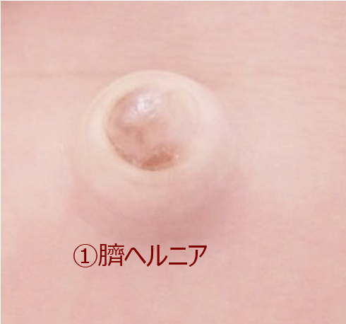 でべそ とは？